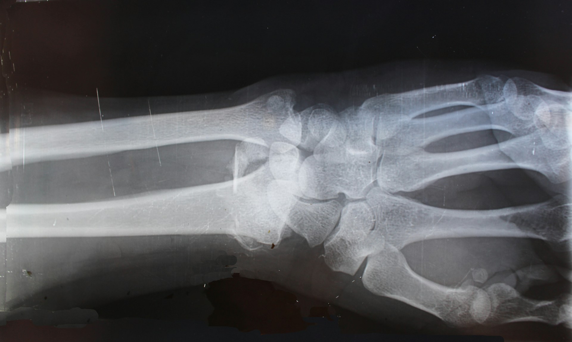 Rehabilitation after fracture